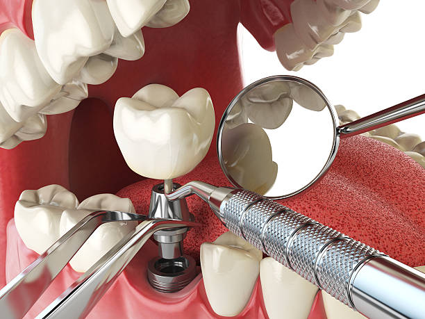 Best Emergency Dentist for Lost Fillings or Crowns in Southgate, MI